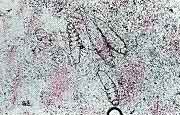 demodex